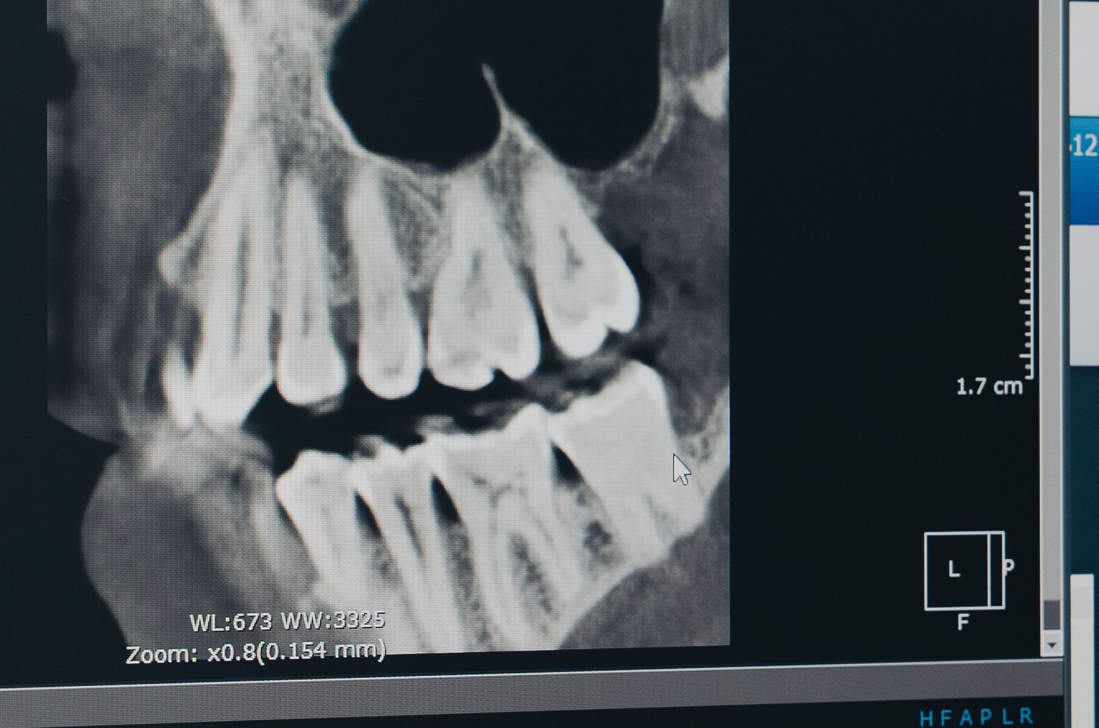 Pantalla del tomógrafo con la planeación de un implante en 3D