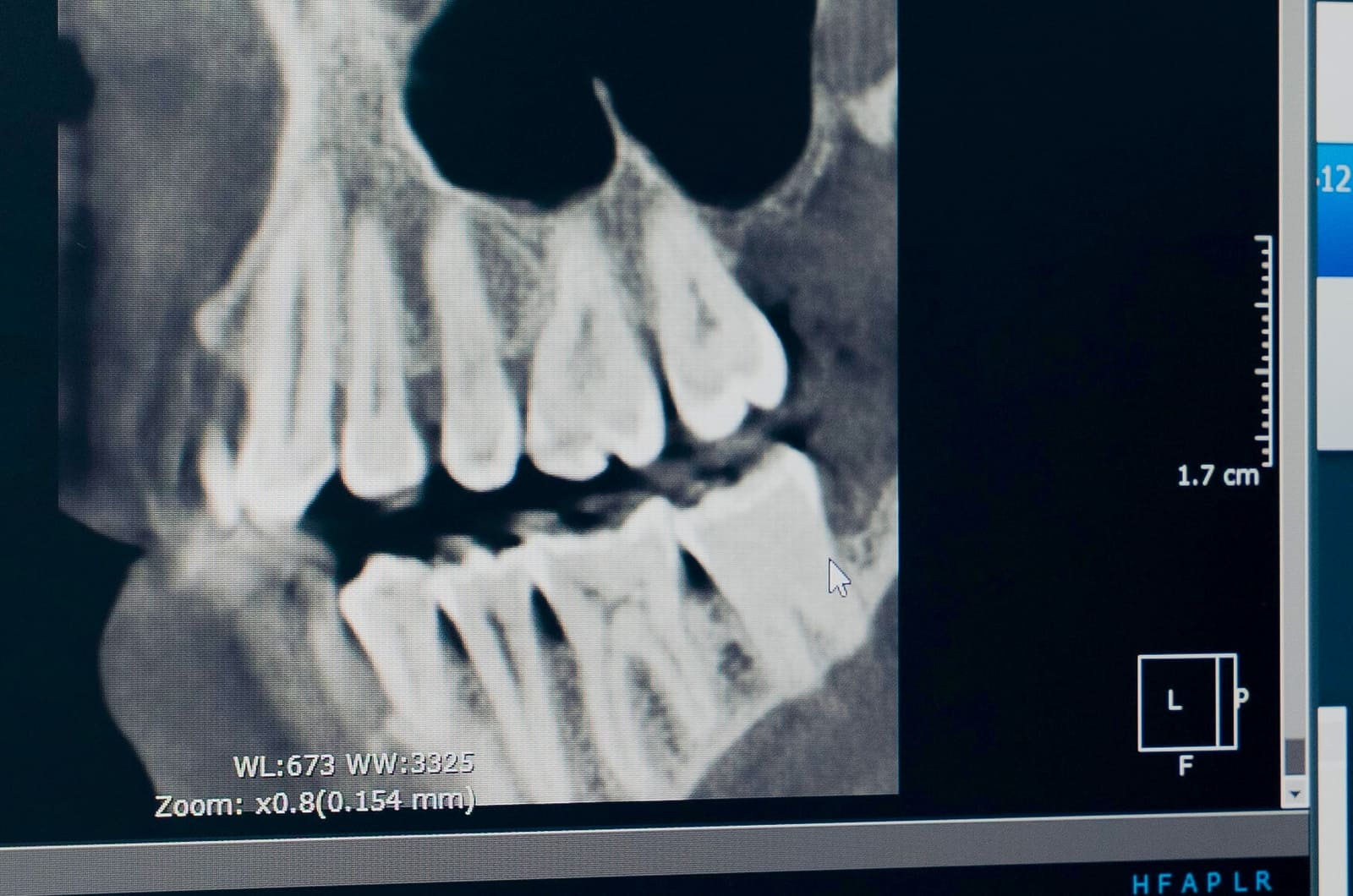Pantalla del tomógrafo con la planeación de un implante en 3D
