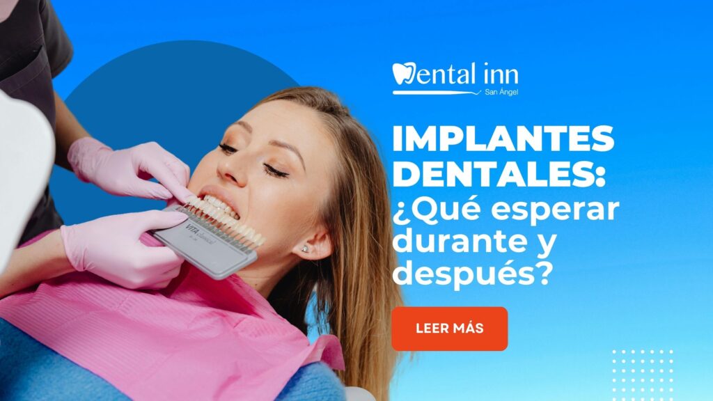 implantes dentales